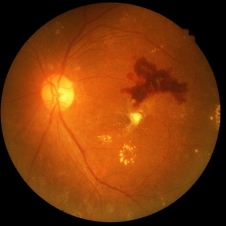 Retina of diabetic - diabetic retinophaty